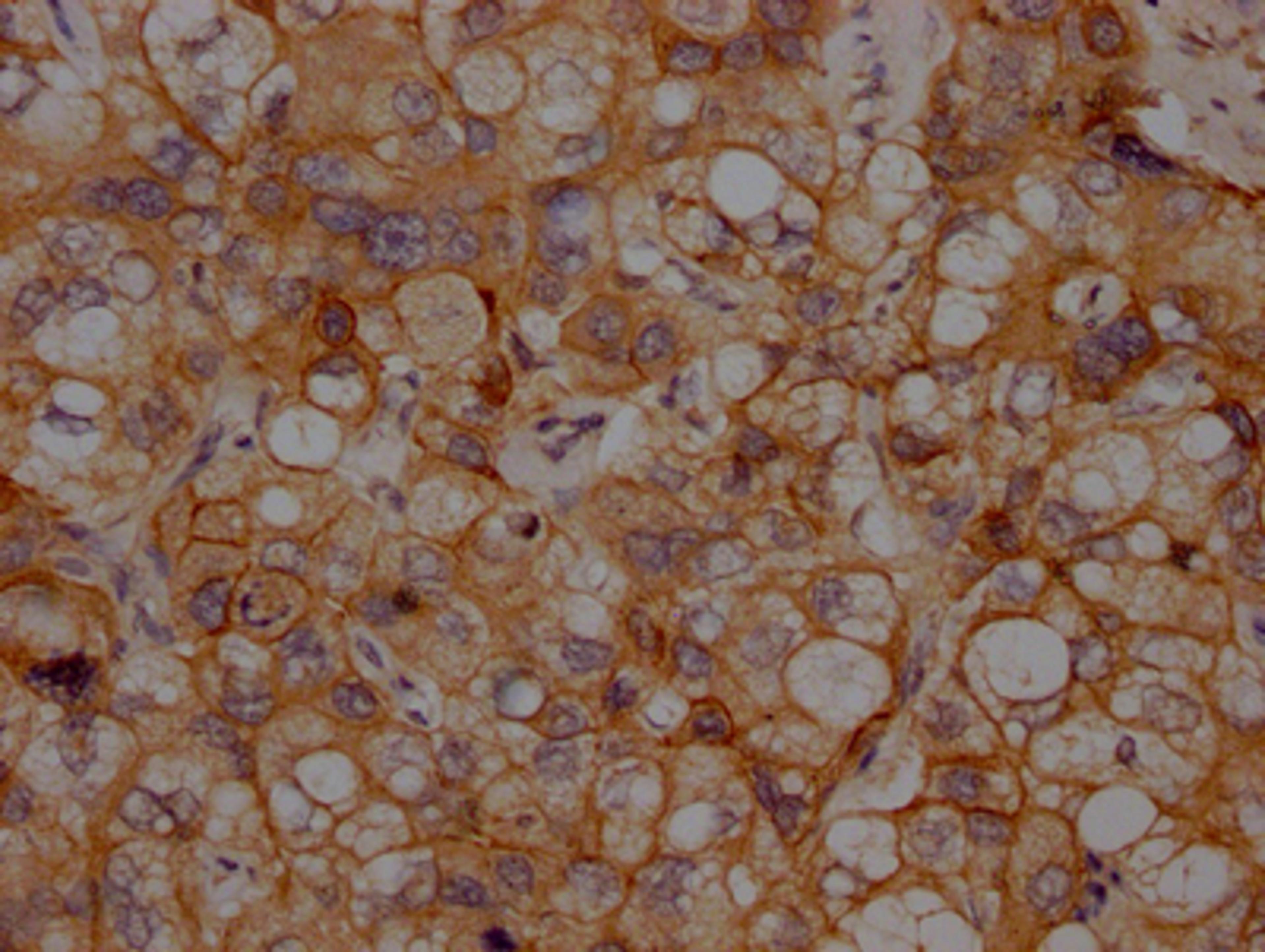 IHC image of CSB-RA243509A0HU diluted at 1:100 and staining in paraffin-embedded human liver cancer performed on a Leica BondTM system. After dewaxing and hydration, antigen retrieval was mediated by high pressure in a citrate buffer (pH 6.0). Section was blocked with 10% normal goat serum 30min at RT. Then primary antibody (1% BSA) was incubated at 4℃ overnight. The primary is detected by a Goat anti-rabbit IgG polymer labeled by HRP and visualized using 0.05% DAB.