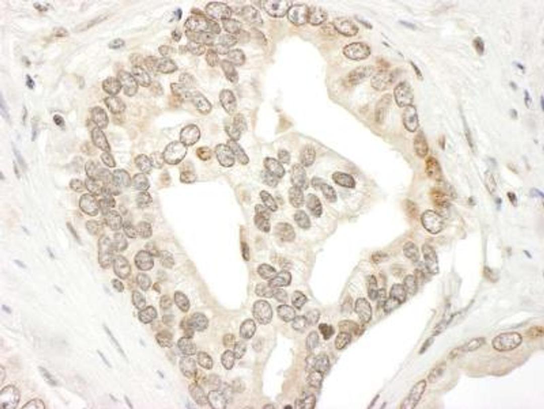 Immunohistochemistry-Paraffin: Jak2 Antibody [NBP1-22975] - Human prostate carcinoma.