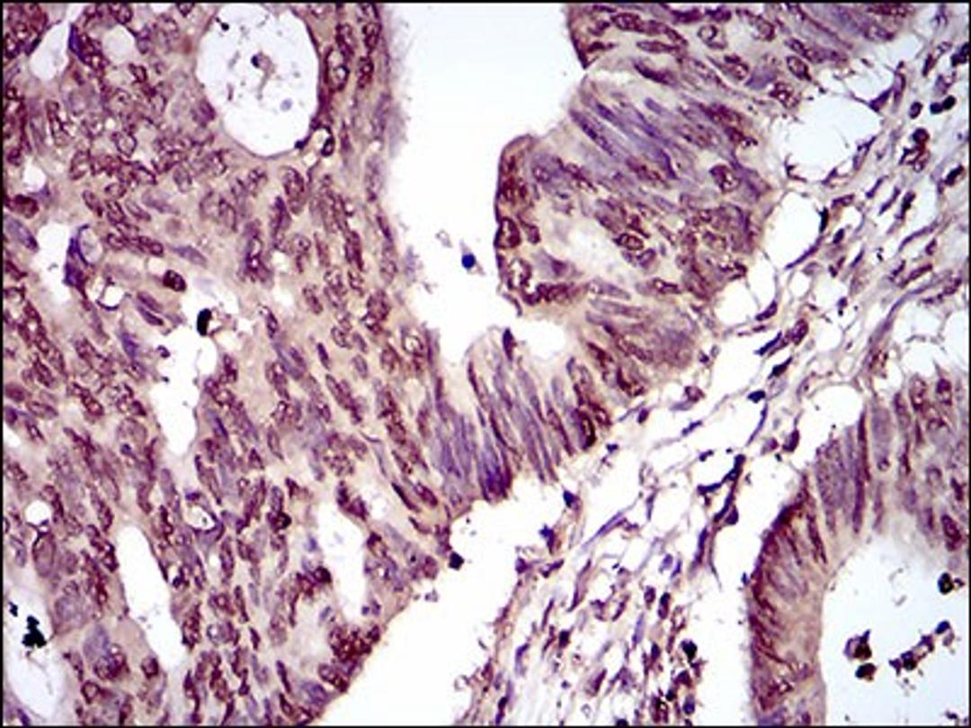 Immunohistochemistry: PIWIL4 Antibody (10G9B11) [NBP2-37398] - Immunohistochemical analysis of paraffin-embedded rectum cancer tissues using PIWIL4 mouse mAb with DAB staining.