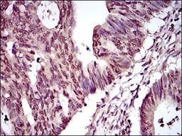 Immunohistochemistry: PIWIL4 Antibody (10G9B11) [NBP2-37398] - Immunohistochemical analysis of paraffin-embedded rectum cancer tissues using PIWIL4 mouse mAb with DAB staining.