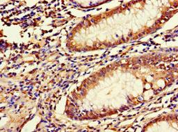 Immunohistochemistry of paraffin-embedded human colon cancer using CSB-PA013178LA01HU at dilution of 1:100