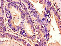 Immunohistochemistry of paraffin-embedded human colon cancer using CSB-PA709608LA01HU at dilution of 1:100