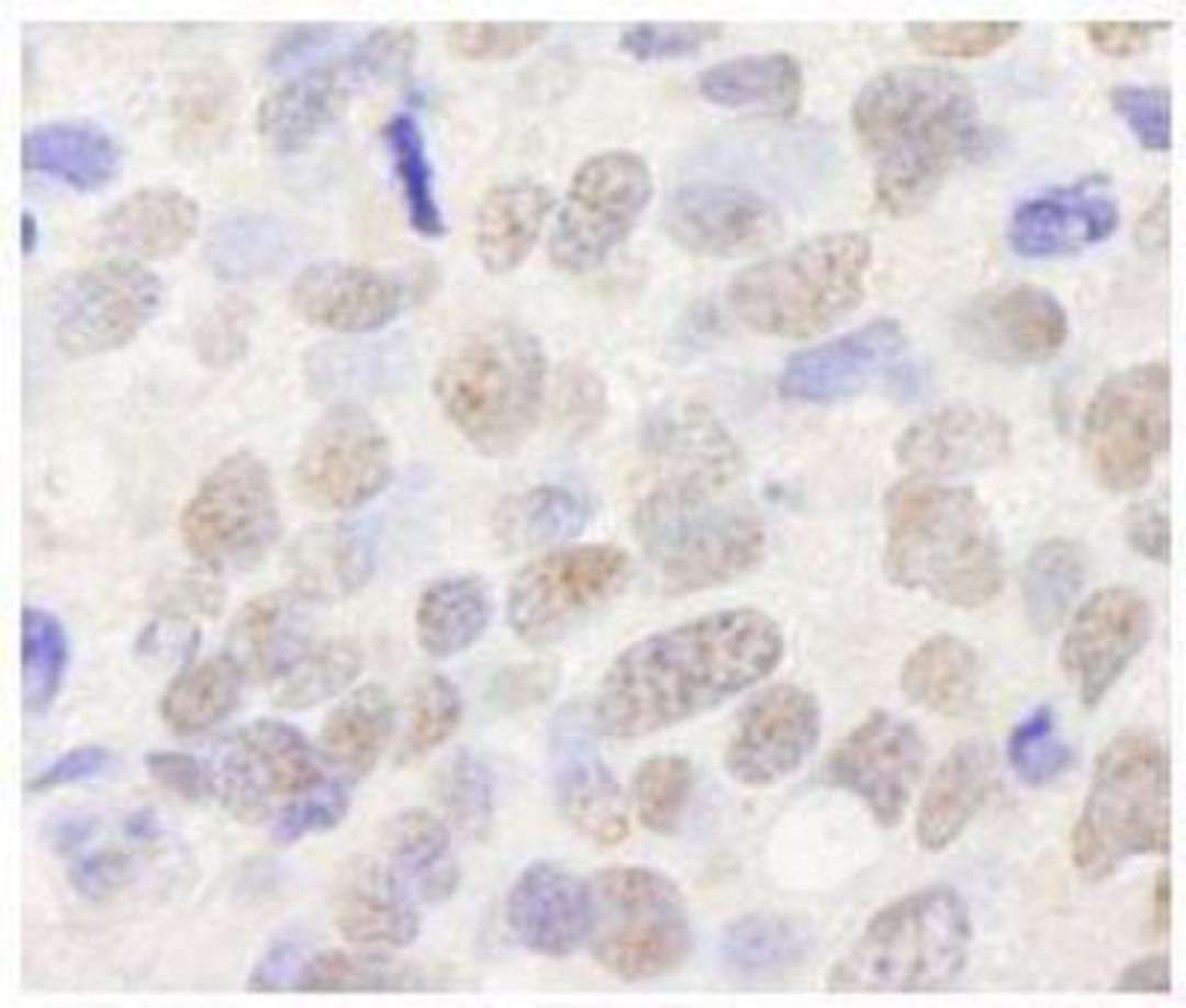 Immunohistochemistry-Paraffin: TIF1 alpha Antibody [NB100-2596] - FFPE section of human breast tumor.  Antibody used at a dilution of 1:250.