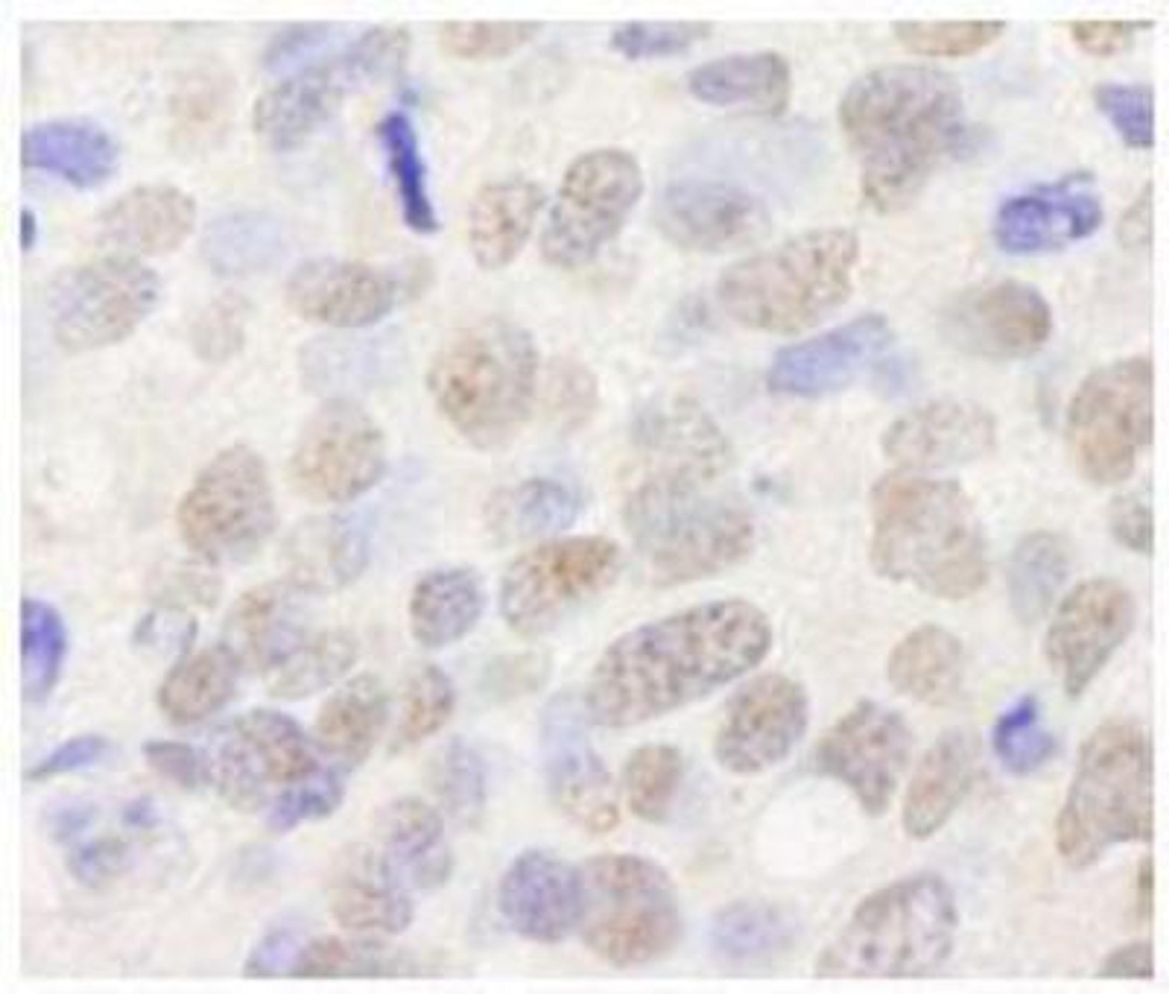 Immunohistochemistry-Paraffin: TIF1 alpha Antibody [NB100-2596] - FFPE section of human breast tumor.  Antibody used at a dilution of 1:250.