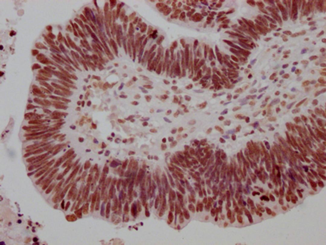 IHC image of CSB-RA279005A0HU diluted at 1:100 and staining in paraffin-embedded human ovarian cancer performed on a Leica BondTM system. After dewaxing and hydration, antigen retrieval was mediated by high pressure in a citrate buffer (pH 6.0). Section was blocked with 10% normal goat serum 30min at RT. Then primary antibody (1% BSA) was incubated at 4℃ overnight. The primary is detected by a Goat anti-rabbit IgG polymer labeled by HRP and visualized using 0.05% DAB.