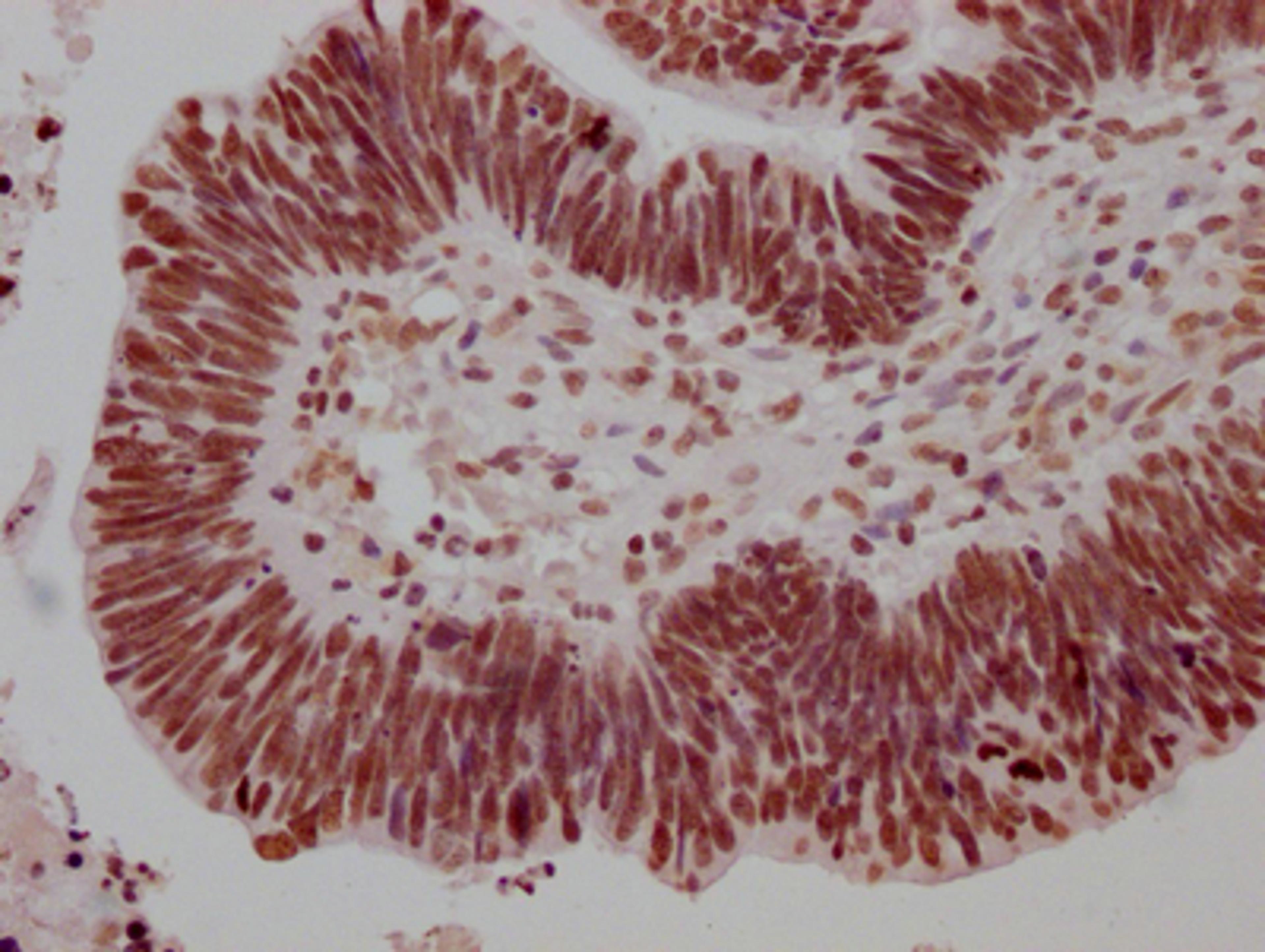 IHC image of CSB-RA279005A0HU diluted at 1:100 and staining in paraffin-embedded human ovarian cancer performed on a Leica BondTM system. After dewaxing and hydration, antigen retrieval was mediated by high pressure in a citrate buffer (pH 6.0). Section was blocked with 10% normal goat serum 30min at RT. Then primary antibody (1% BSA) was incubated at 4℃ overnight. The primary is detected by a Goat anti-rabbit IgG polymer labeled by HRP and visualized using 0.05% DAB.