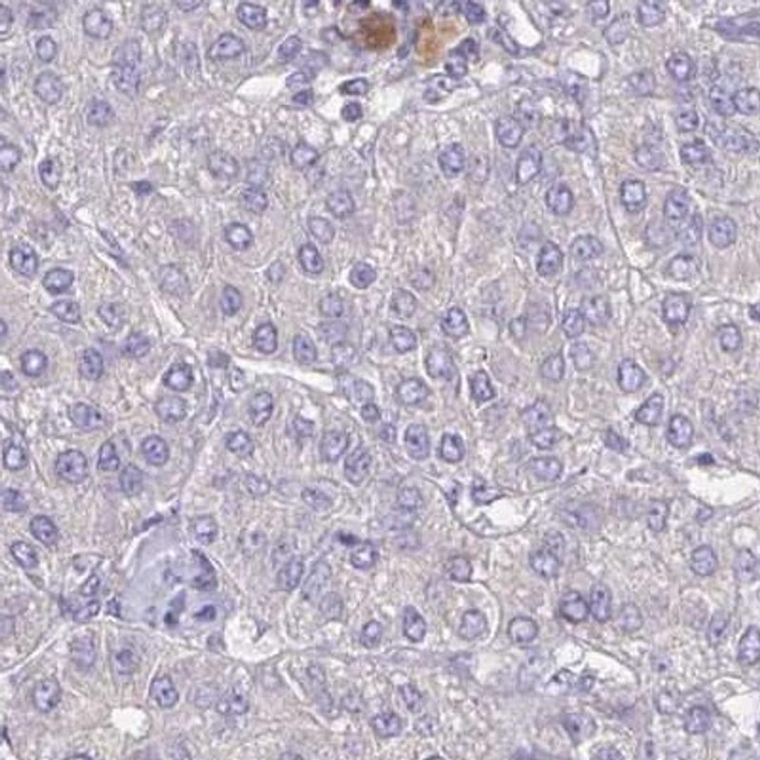 Immunohistochemistry: YJEFN3 Antibody [NBP2-32568] - liver cancer