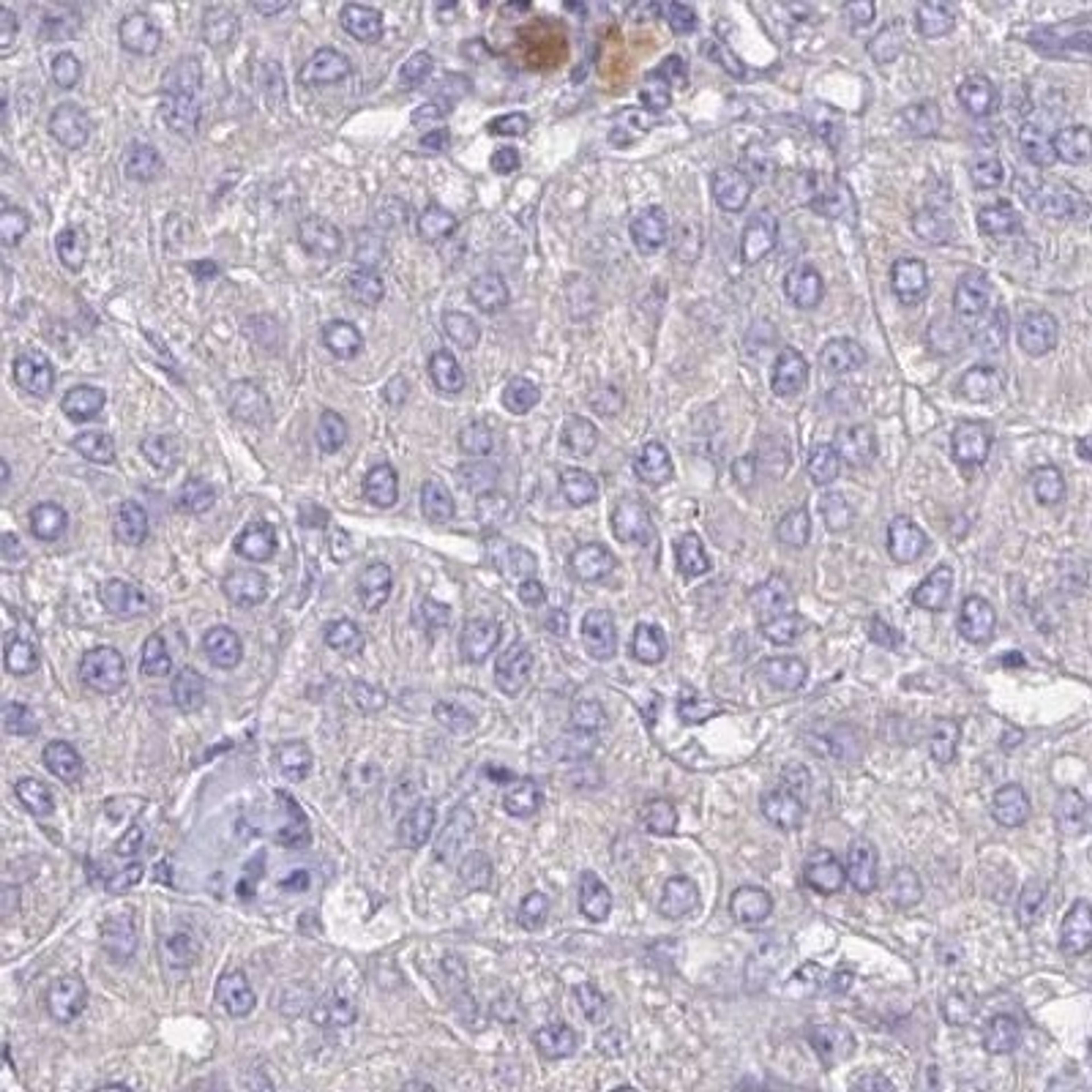 Immunohistochemistry: YJEFN3 Antibody [NBP2-32568] - liver cancer