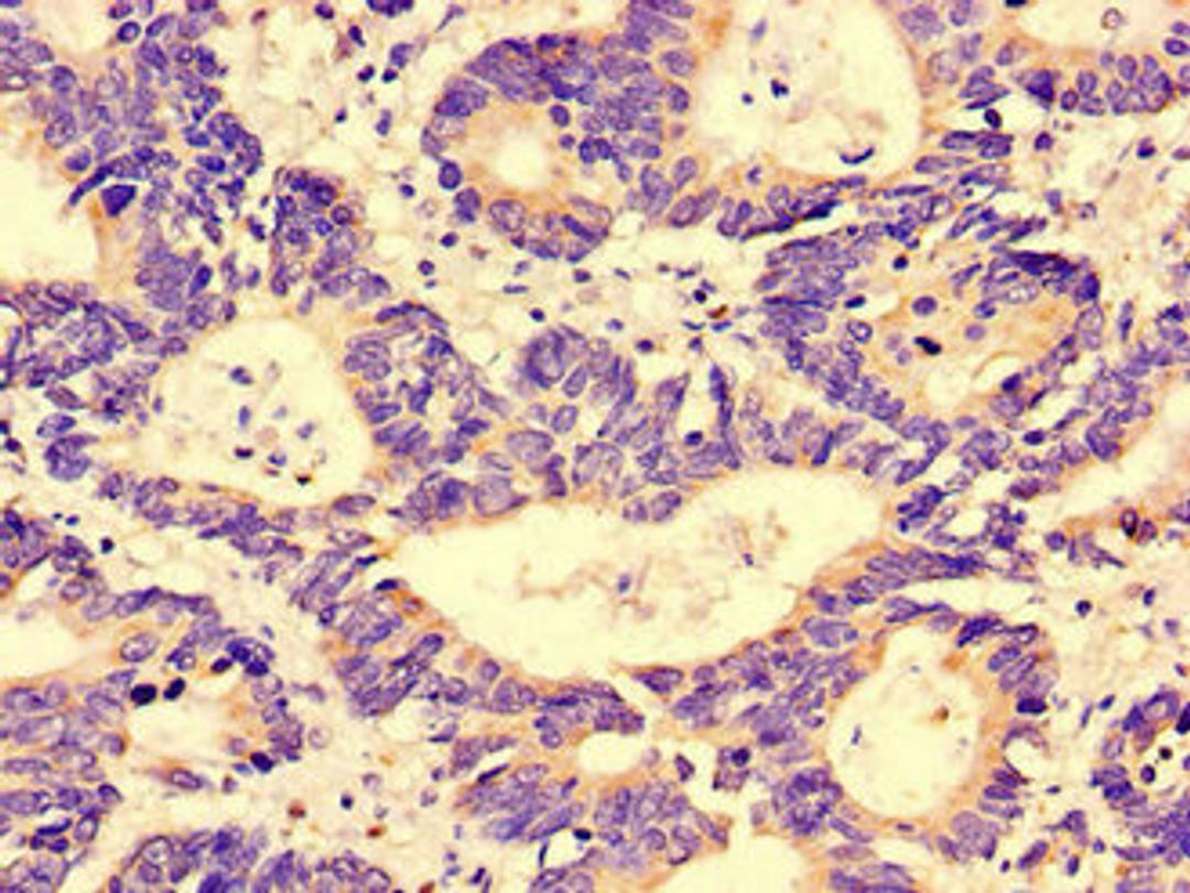 Immunohistochemistry of paraffin-embedded human colon cancer using CSB-PA890911LA01HU at dilution of 1:100