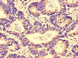 Immunohistochemistry of paraffin-embedded human colon cancer using CSB-PA890911LA01HU at dilution of 1:100