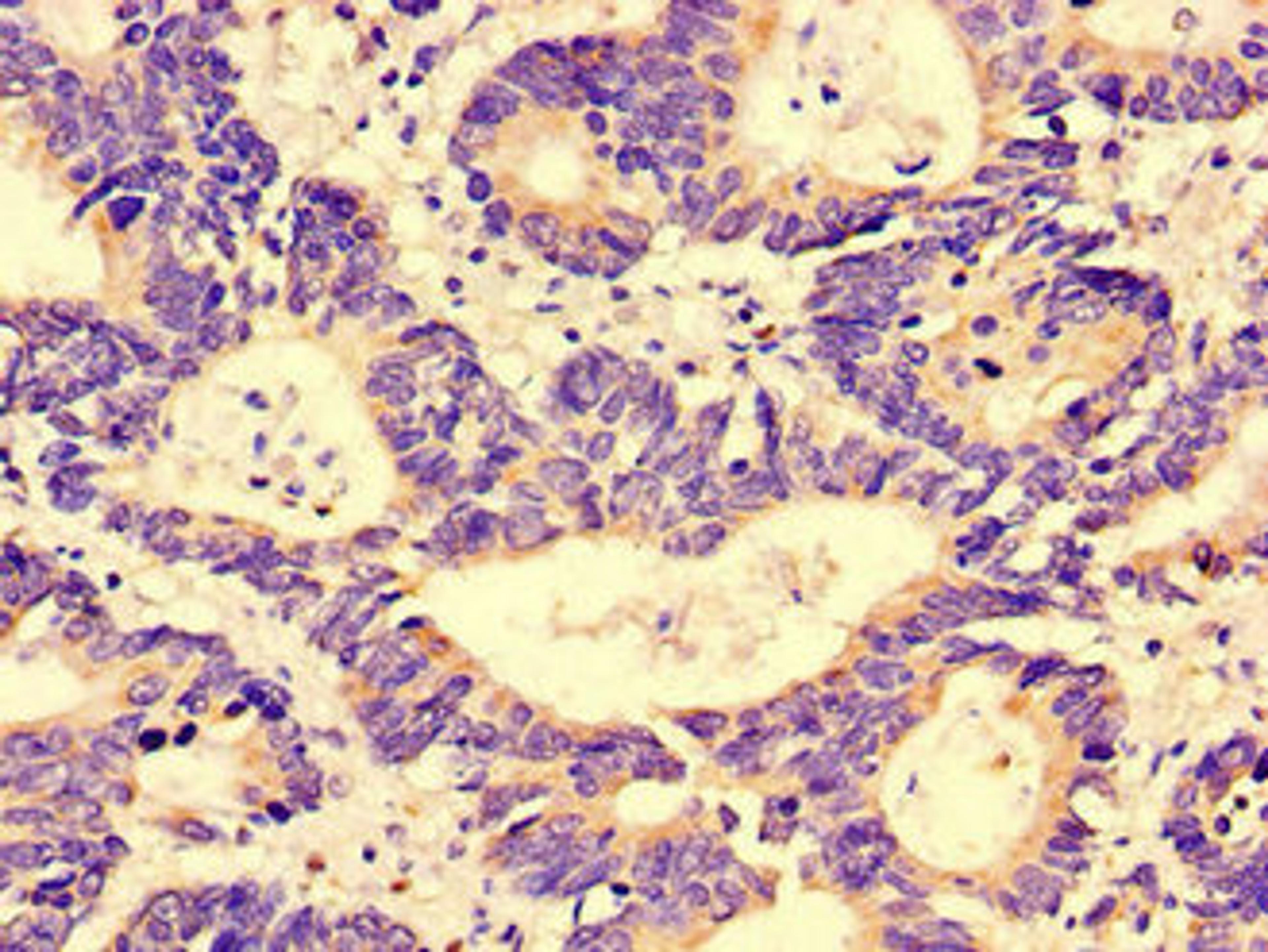 Immunohistochemistry of paraffin-embedded human colon cancer using CSB-PA890911LA01HU at dilution of 1:100