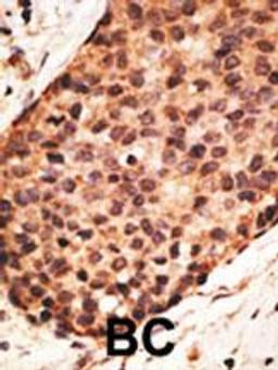 Formalin-fixed and paraffin-embedded human cancer tissue reacted with the primary antibody, which was peroxidase-conjugated to the secondary antibody, followed by AEC staining. BC = breast carcinoma; HC = hepatocarcinoma.