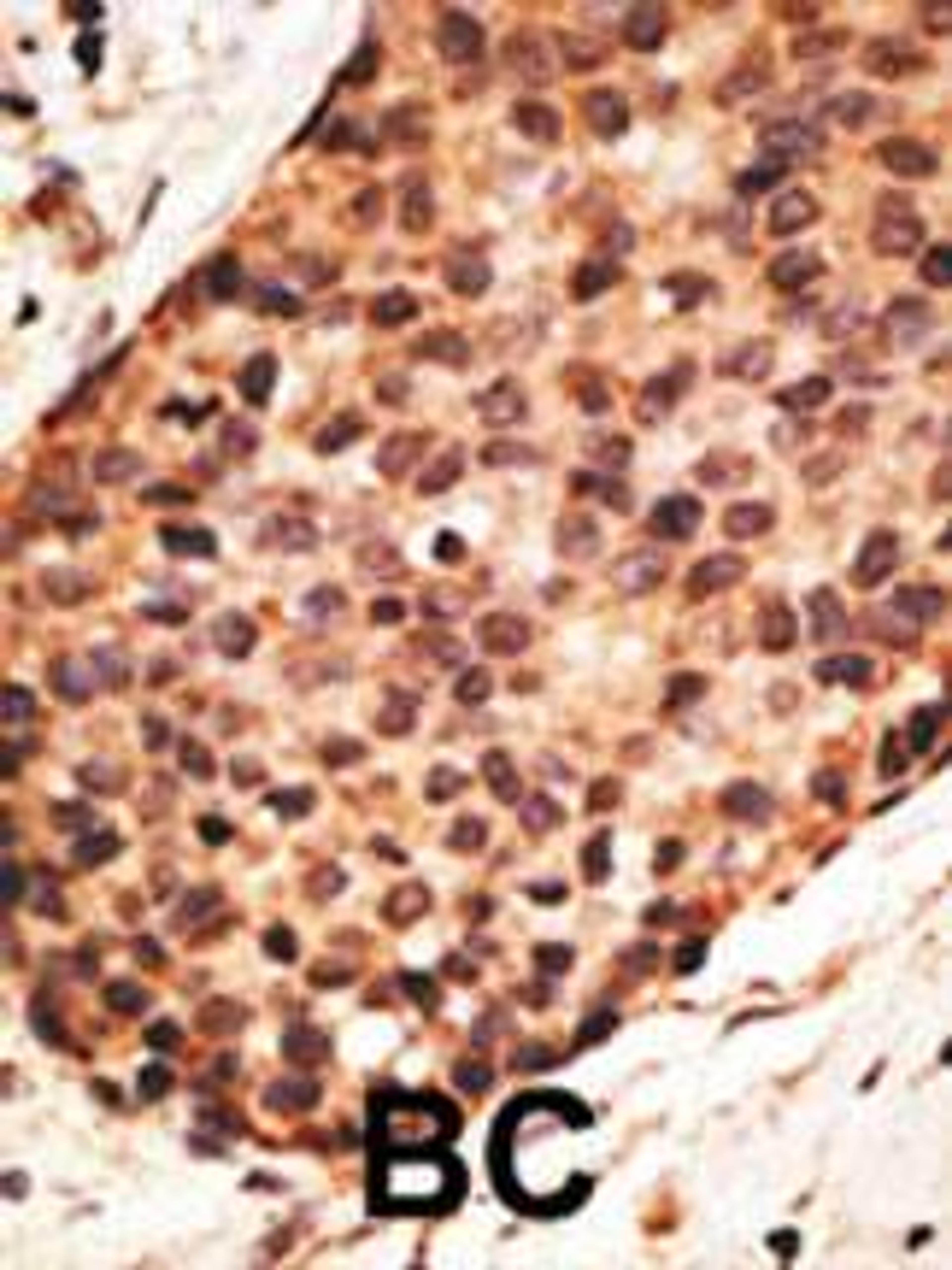Formalin-fixed and paraffin-embedded human cancer tissue reacted with the primary antibody, which was peroxidase-conjugated to the secondary antibody, followed by AEC staining. BC = breast carcinoma; HC = hepatocarcinoma.