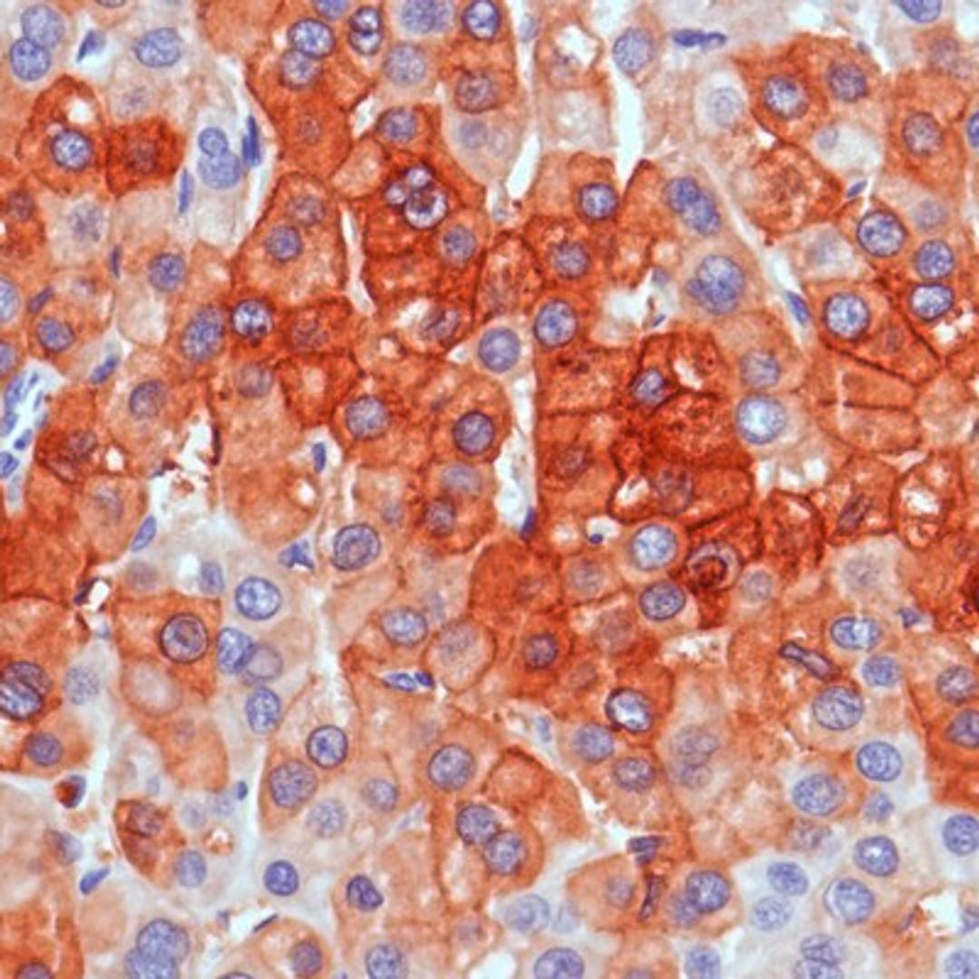 Immunohistochemistry-Paraffin: TNS4 Antibody (SP83) [NBP2-12488] Human Liver Carcinoma