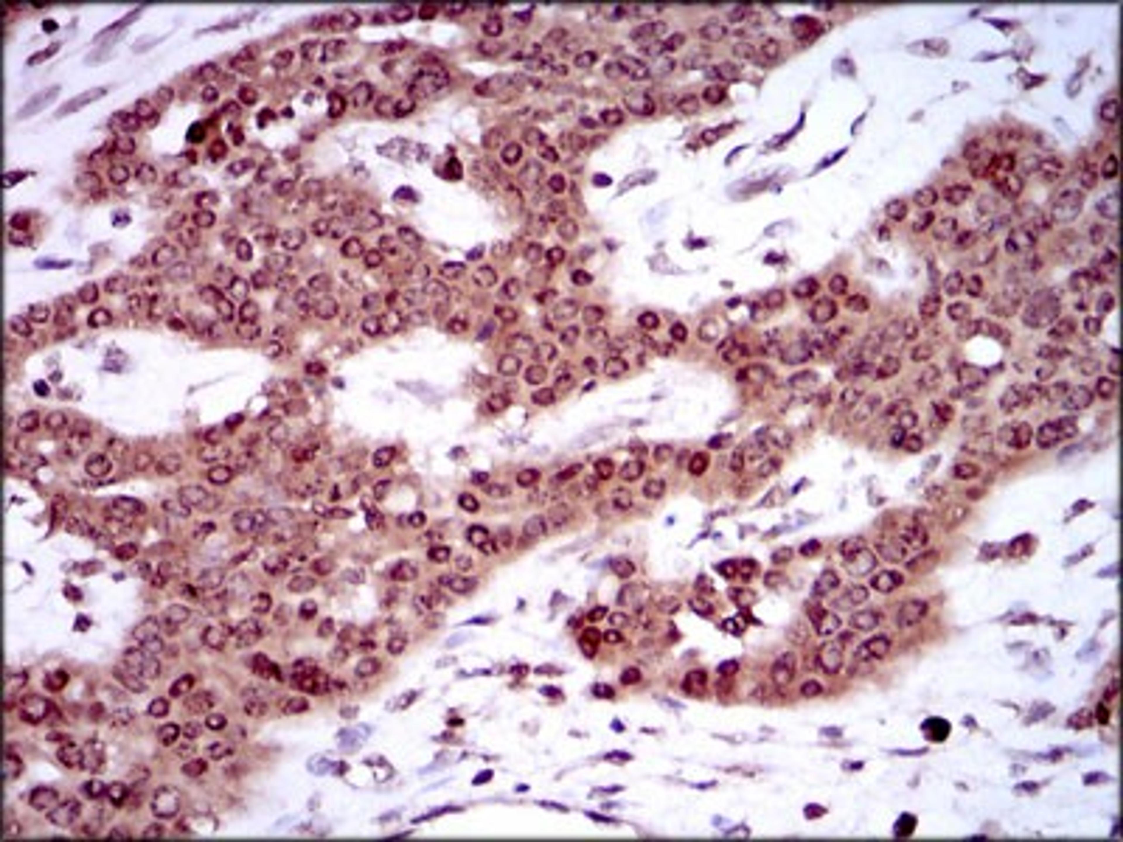 Immunohistochemistry: SRY Antibody (1G4) [NBP2-37463] - Immunohistochemical analysis of paraffin-embedded ovarian cancer tissues using SRY mouse mAb with DAB staining.