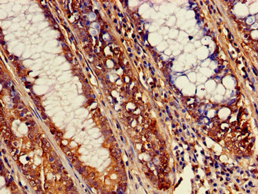 Immunohistochemistry of paraffin-embedded human colon cancer using CSB-PA002328LA01HU at dilution of 1:100