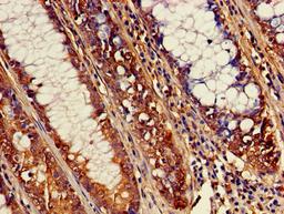 Immunohistochemistry of paraffin-embedded human colon cancer using CSB-PA002328LA01HU at dilution of 1:100