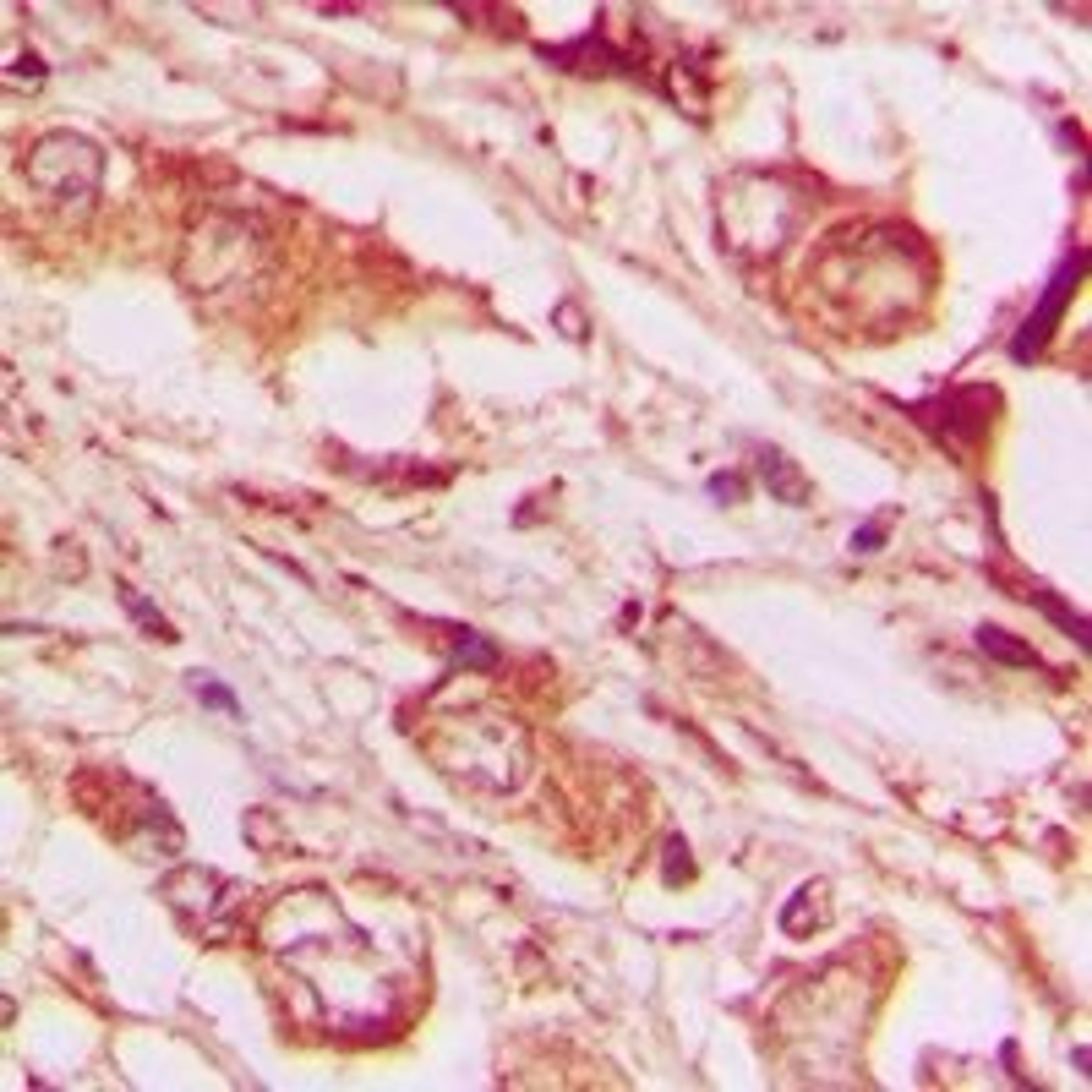 Immunohistochemical staining of human lung cancer tissue using RNASE11 antibody