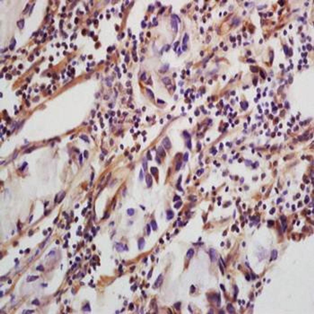 Immunohistochemical analysis of formalin-fixed and paraffin embedded human colon carcinoma tissue (dilution at:1:200) using CLEC5A antibody