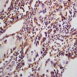 Immunohistochemical analysis of formalin-fixed and paraffin embedded human colon carcinoma tissue (dilution at:1:200) using CLEC5A antibody