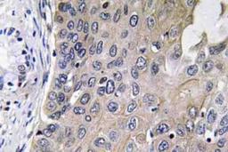 Immunohistochemistry-Paraffin: Guanylyl Cyclase alpha 1 Antibody [NBP2-13000] - Paraffin-embedded human lung carcinoma tissue.