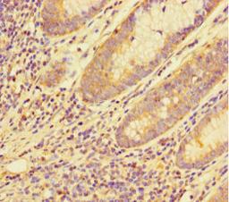 Immunohistochemistry of paraffin-embedded human colon cancer using CSB-PA862046LA01HU at dilution of 1:100