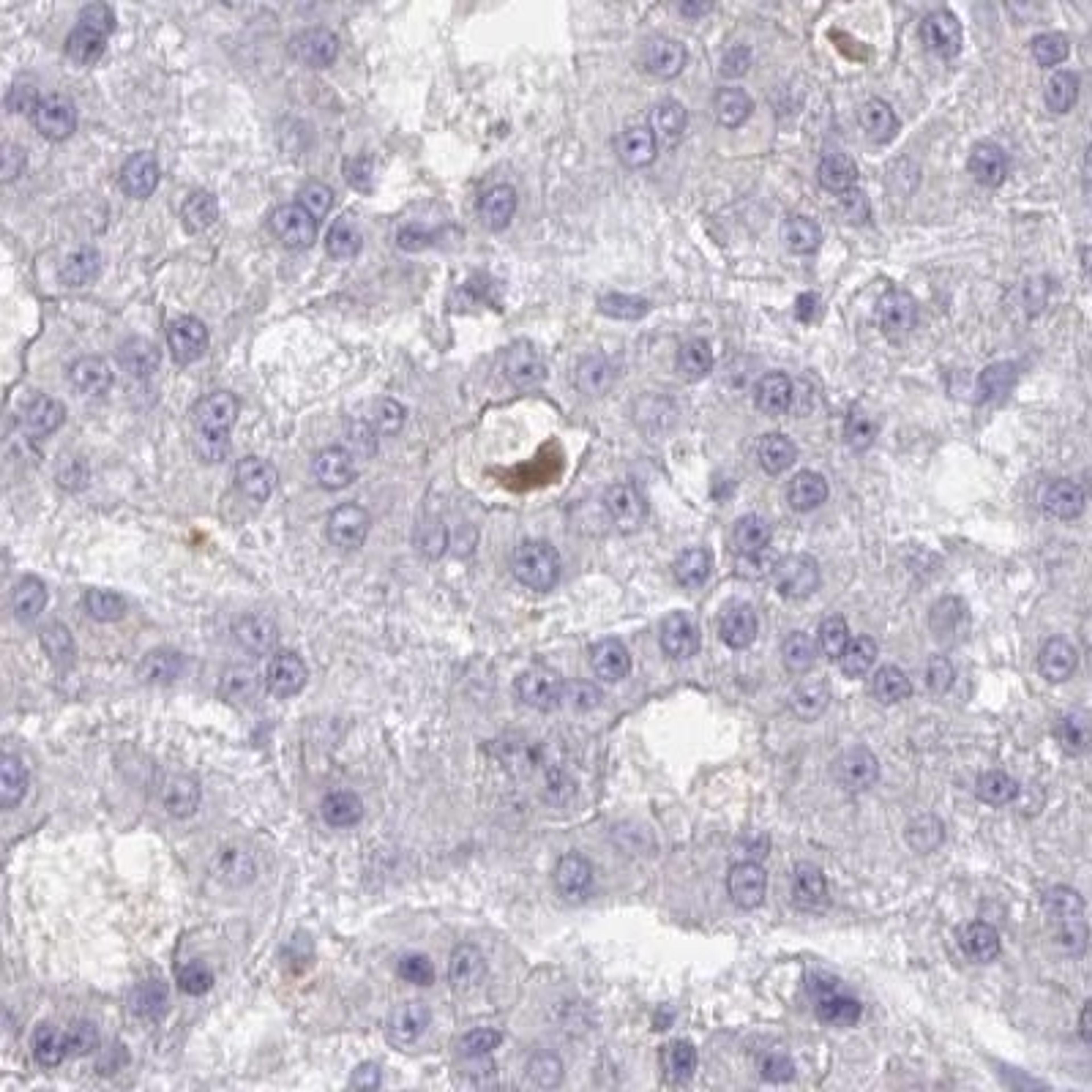 Immunohistochemistry: RNASEH2C Antibody [NBP2-31792] - liver cancer