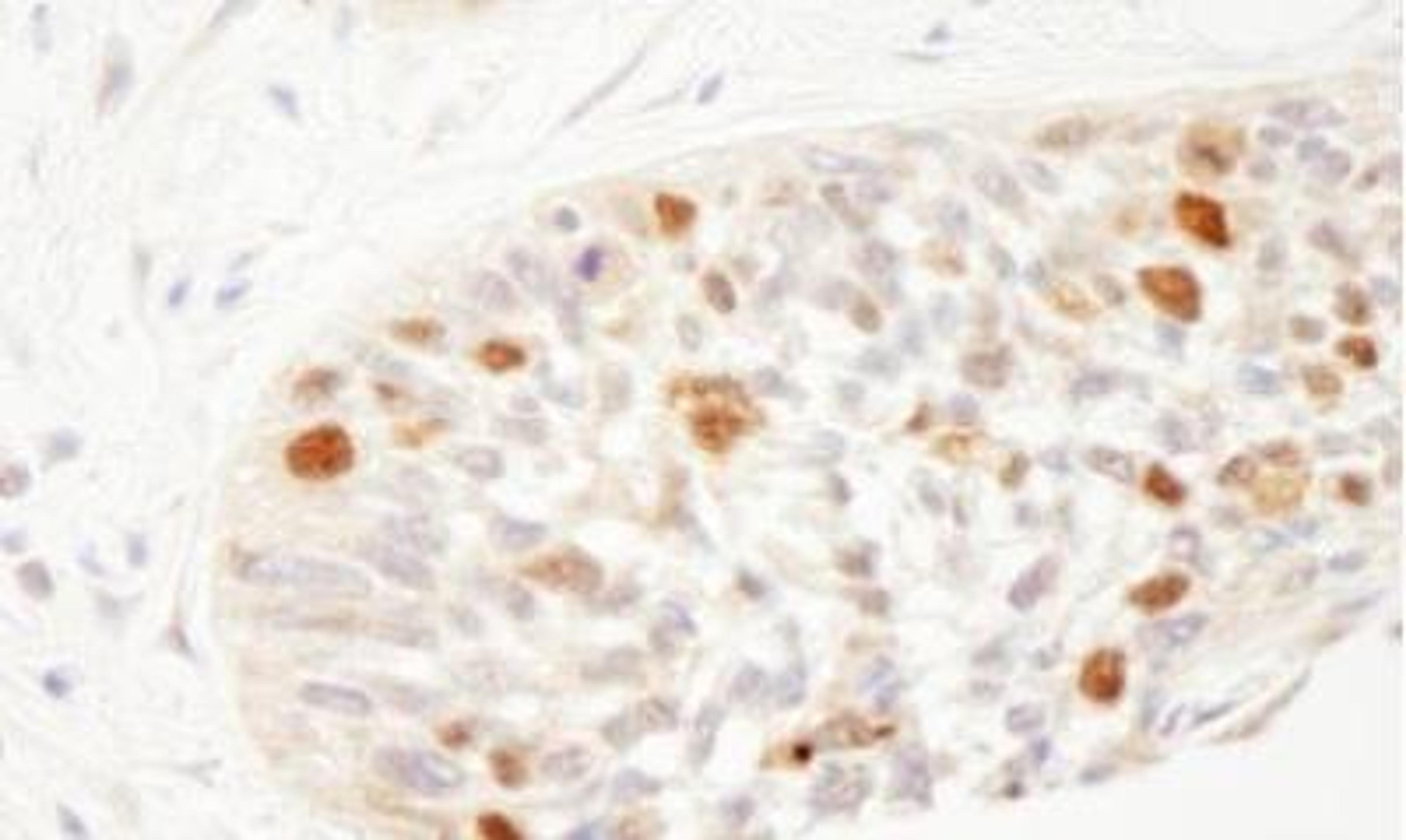 Immunohistochemistry-Paraffin: Importin alpha 2/KPNA2 Antibody [NB100-79807] - Section of human laryngeal squamous cell carcinoma. Antibody: Affinity purified rabbit anti-RCH1 used at a dilution of 1:1,000 (1ug/ml). Detection: DAB