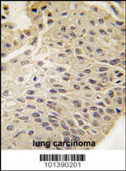 Formalin-fixed and paraffin-embedded human lung carcinoma tissue reacted with GJB5 Antibody , which was peroxidase-conjugated to the secondary antibody, followed by DAB staining.