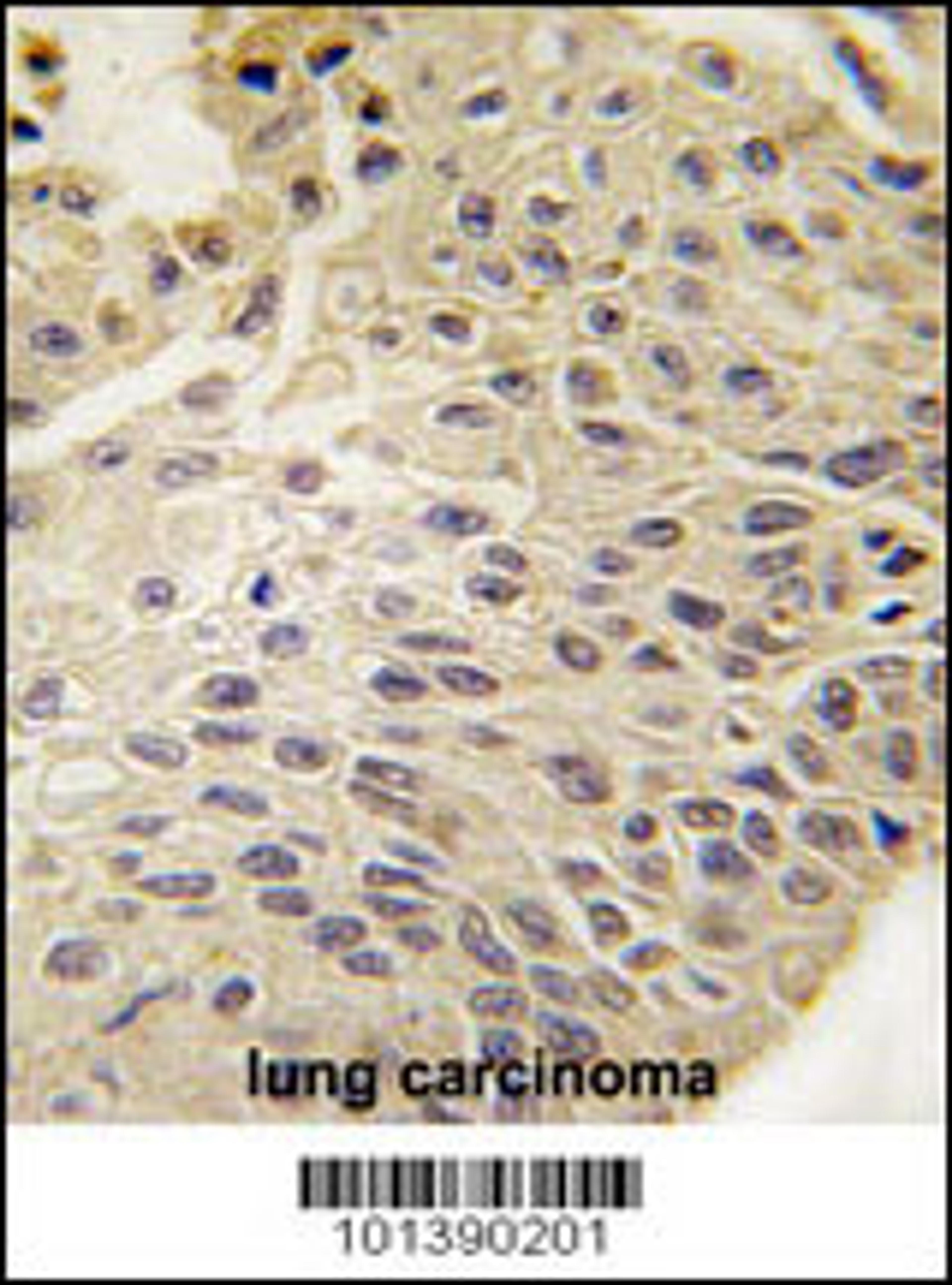 Formalin-fixed and paraffin-embedded human lung carcinoma tissue reacted with GJB5 Antibody , which was peroxidase-conjugated to the secondary antibody, followed by DAB staining.