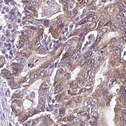 Immunohistochemistry: CHIA Antibody [NBP2-32440] - stomach cancer