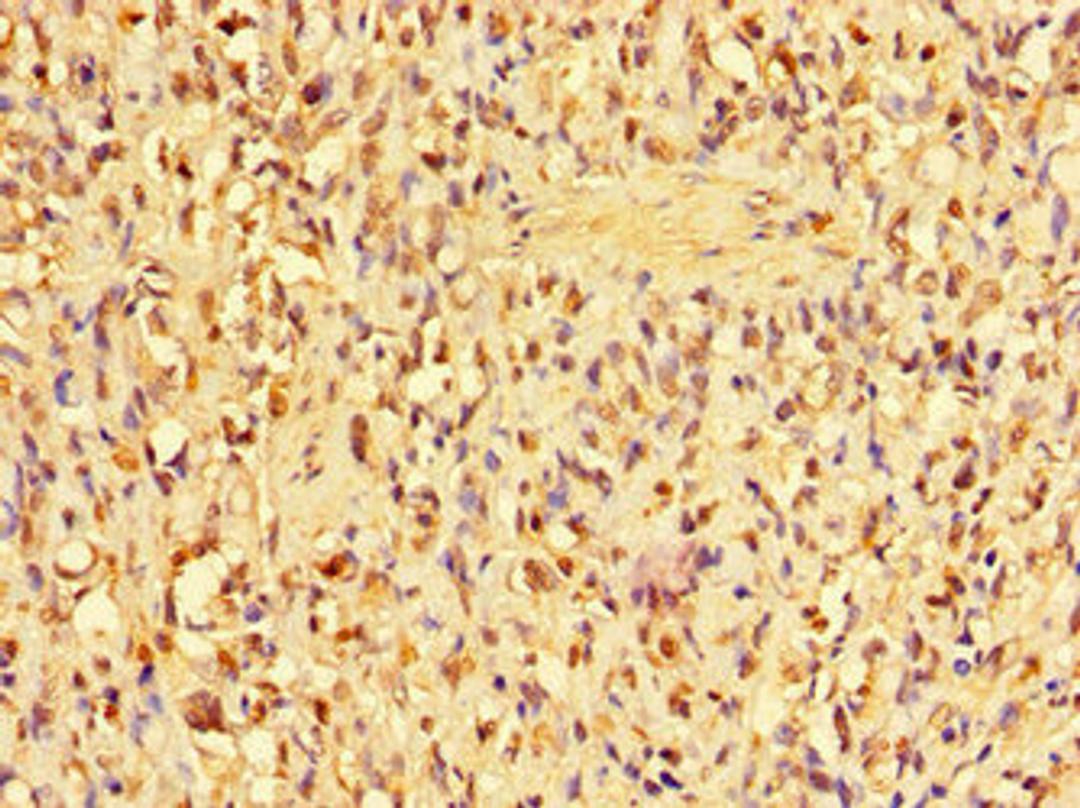 Immunohistochemistry of paraffin-embedded human gastric cancer using CSB-PA001825LA01HU at dilution of 1:100