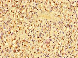 Immunohistochemistry of paraffin-embedded human gastric cancer using CSB-PA001825LA01HU at dilution of 1:100