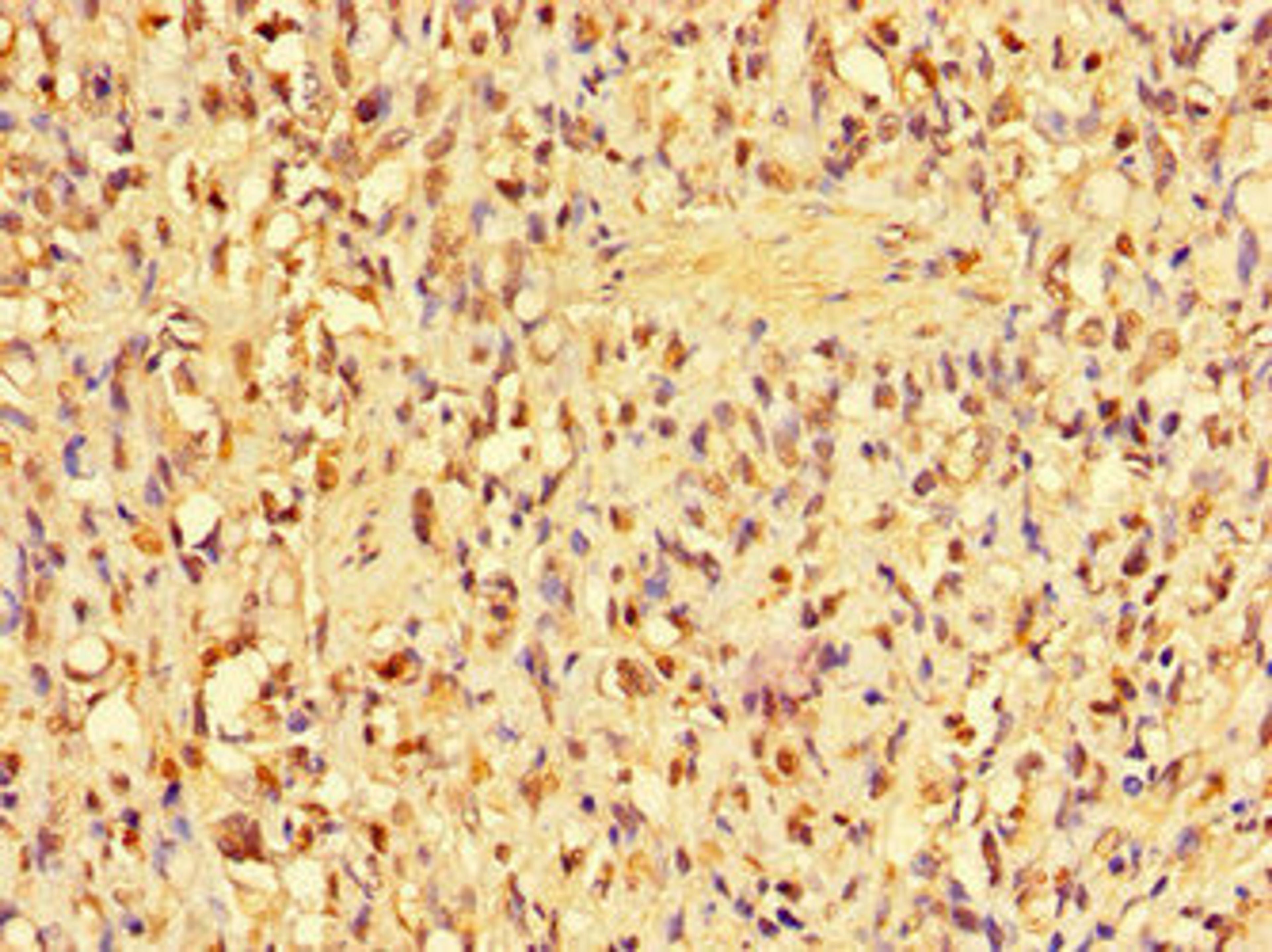 Immunohistochemistry of paraffin-embedded human gastric cancer using CSB-PA001825LA01HU at dilution of 1:100