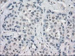 Immunohistochemistry-Paraffin: Aurora C Antibody (2B7) [NBP1-47663] - Staining of paraffin-embedded Adenocarcinoma of breast tissue using anti-Aurora C mouse monoclonal antibody.