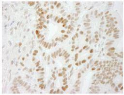 Immunohistochemistry-Paraffin: Smek1 Antibody [NB100-2879] - FFPE section of human stomach carcinoma.  Antibody used at a dilution of 1:250.