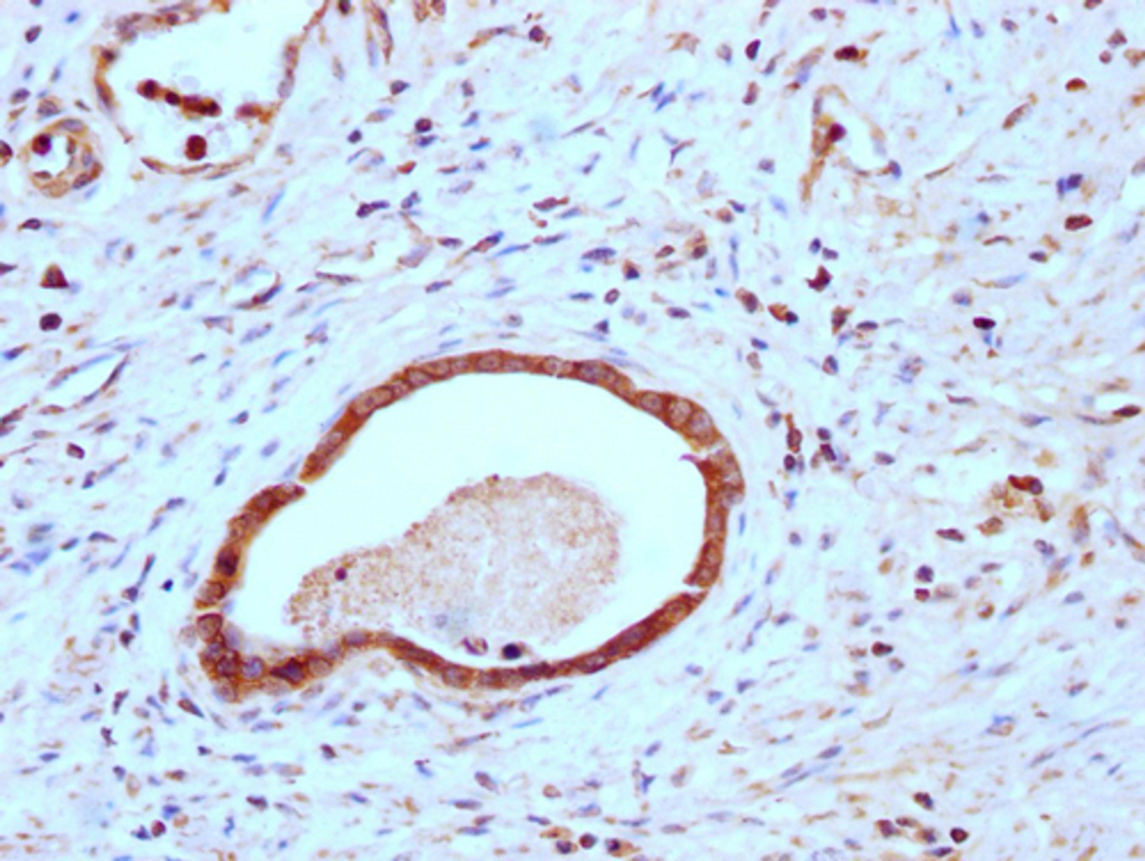 IHC image of CSB-PA005498LA01HU diluted at 1:200 and staining in paraffin-embedded human gastric cancer performed on a Leica BondTM system. After dewaxing and hydration, antigen retrieval was mediated by high pressure in a citrate buffer (pH 6.0). Section was blocked with 10% normal goat serum 30min at RT. Then primary antibody (1% BSA) was incubated at 4°C overnight. The primary is detected by a Goat anti-rabbit polymer IgG labeled by HRP and visualized using 0.05% DAB.