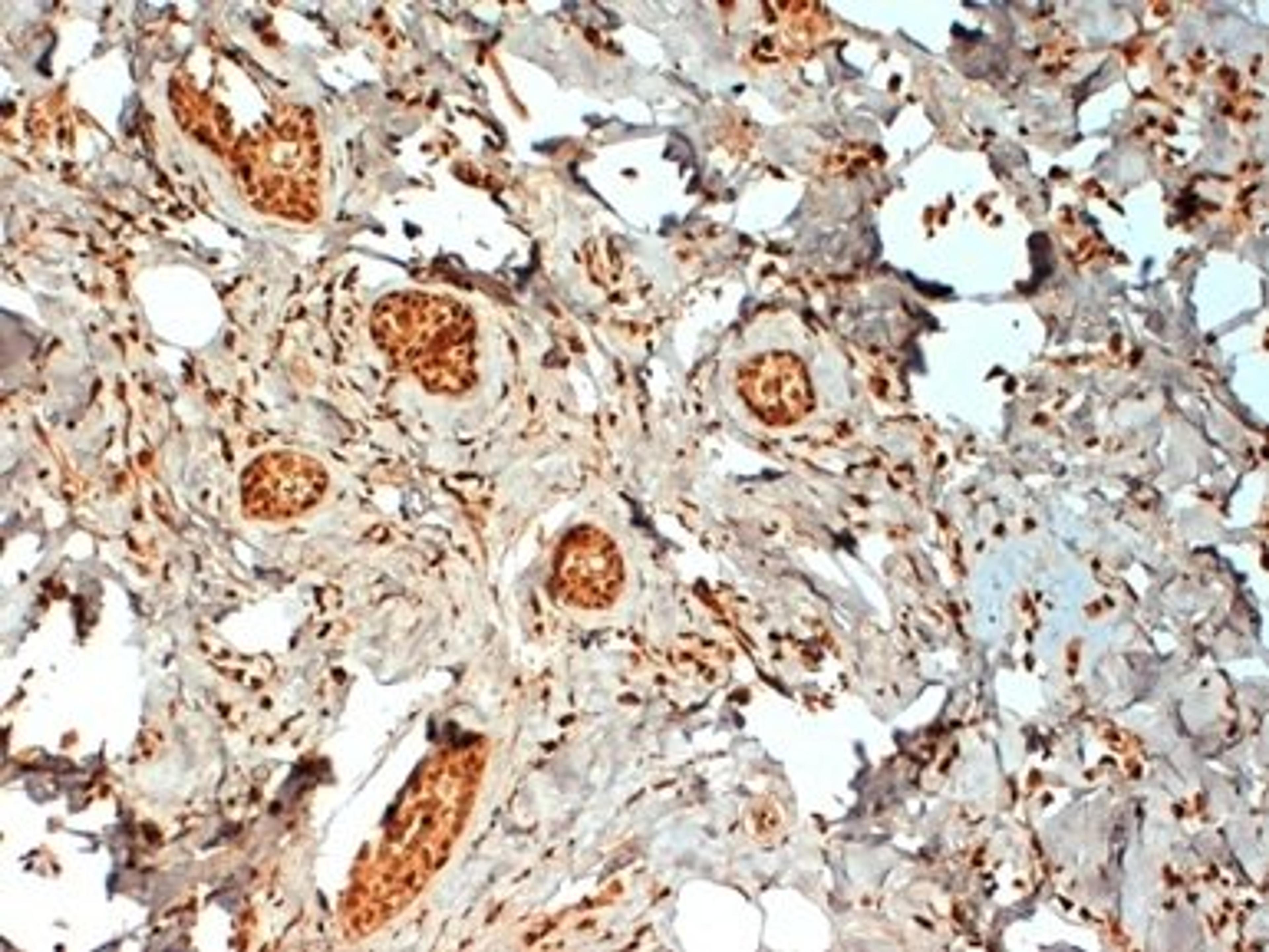 FFPE human breast cancer biopsy stained with Mouse anti Human estrogen receptor beta 2 antibody