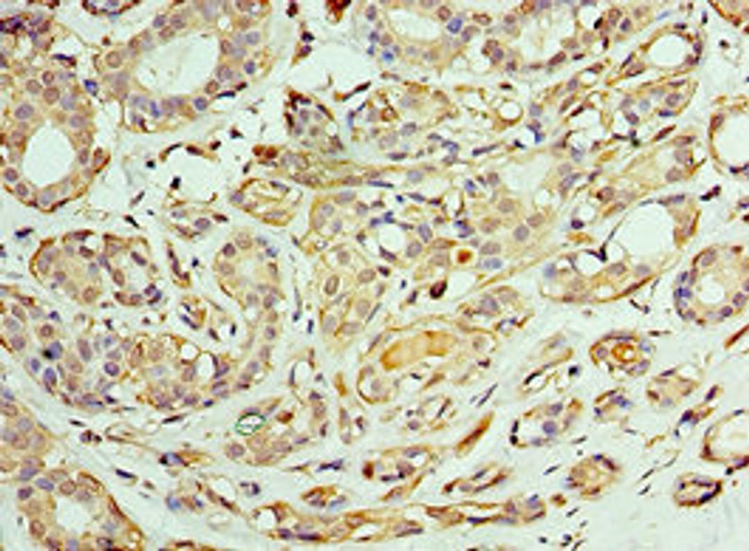 Immunohistochemistry of paraffin-embedded human breast cancer using CSB-PA004865ESR1HU at dilution of 1:100