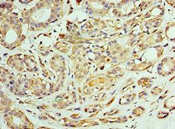 Immunohistochemistry of paraffin-embedded human breast cancer using CSB-PA004865ESR1HU at dilution of 1:100