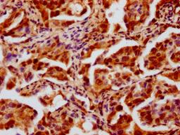 IHC image of CSB-PA010429OA12nhibHU diluted at 1:20 and staining in paraffin-embedded human lung cancer performed on a Leica BondTM system. After dewaxing and hydration, antigen retrieval was mediated by high pressure in a citrate buffer (pH 6.0). Section was blocked with 10% normal goat serum 30min at RT. Then primary antibody (1% BSA) was incubated at 4&deg;C overnight. The primary is detected by a biotinylated secondary antibody and visualized using an HRP conjugated SP system.