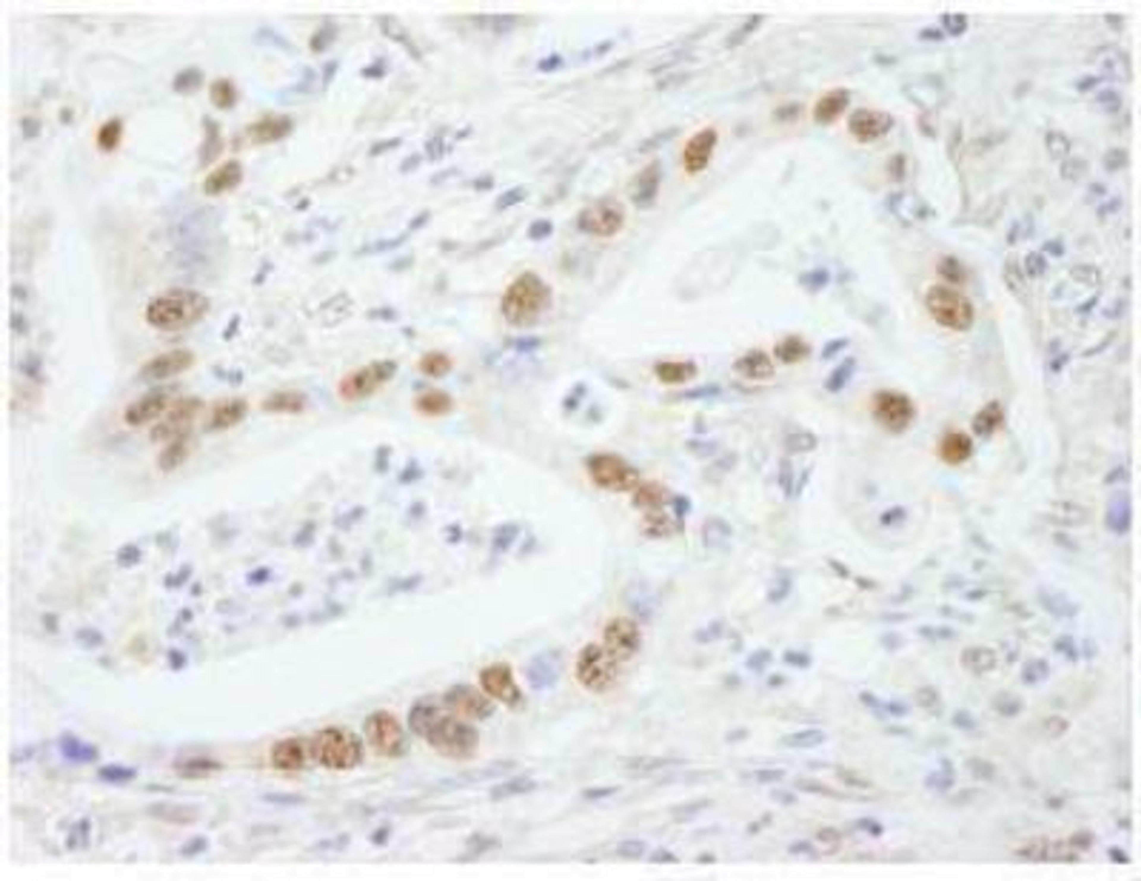 Immunohistochemistry-Paraffin: SF3B2 Antibody [NB100-79847] - Detection of Human SF3b145/SAP145 by Immunohistochemistry. Sample: FFPE section of human stomach carcinoma. Antibody: Affinity purified rabbit anti- SF3b145/SAP145 used at a dilution of 1:250. Detection: DAB staining using Immunohistochemistry Accessory Kit.