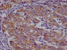 IHC image of CSB-RA959139A0HU diluted at 1:100 and staining in paraffin-embedded human colon cancer performed on a Leica BondTM system. After dewaxing and hydration, antigen retrieval was mediated by high pressure in a citrate buffer (pH 6.0). Section was blocked with 10% normal goat serum 30min at RT. Then primary antibody (1% BSA) was incubated at 4°C overnight. The primary is detected by a Goat anti-rabbit polymer IgG labeled by HRP and visualized using 0.05% DAB.