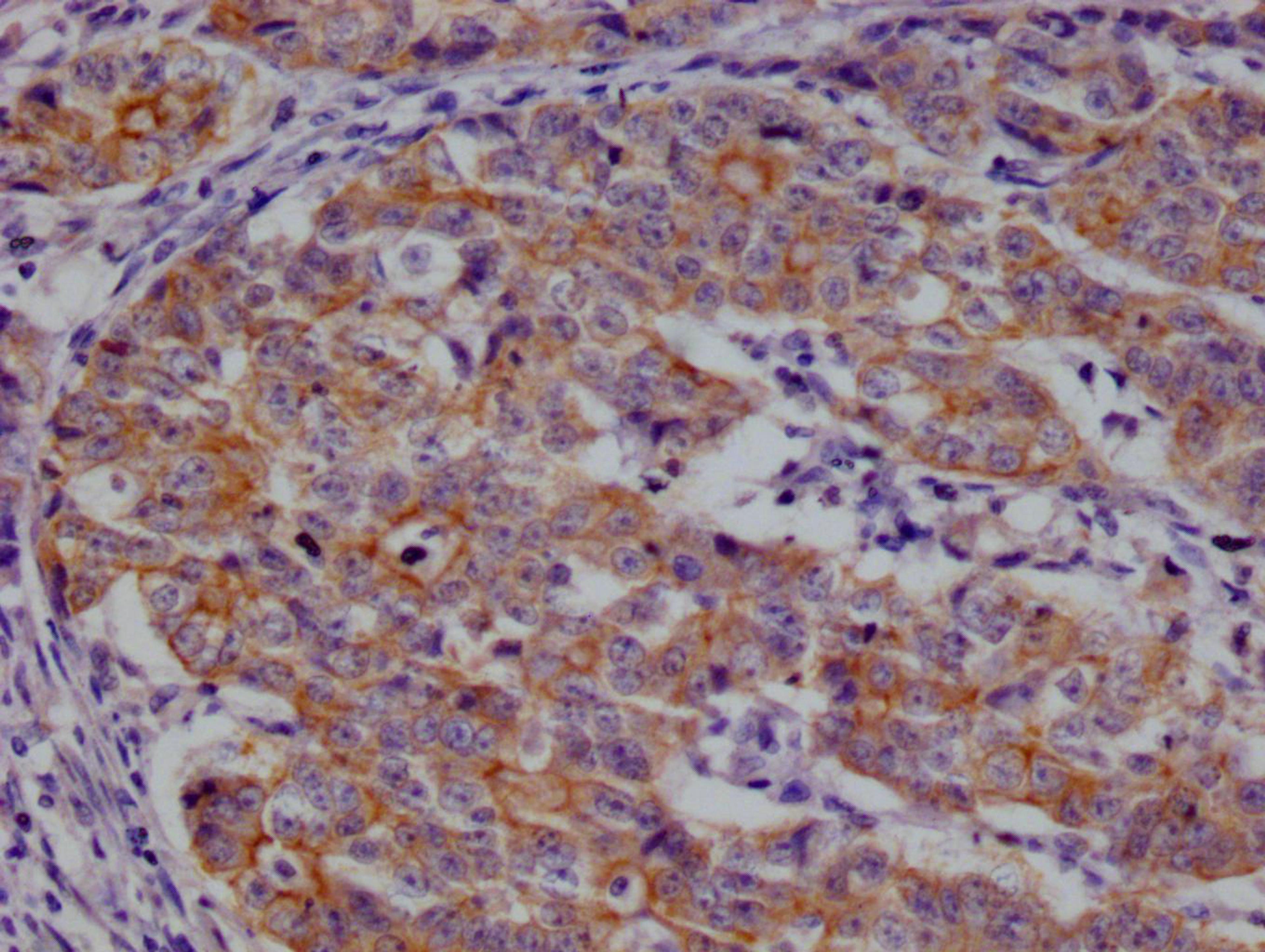 IHC image of CSB-RA959139A0HU diluted at 1:100 and staining in paraffin-embedded human colon cancer performed on a Leica BondTM system. After dewaxing and hydration, antigen retrieval was mediated by high pressure in a citrate buffer (pH 6.0). Section was blocked with 10% normal goat serum 30min at RT. Then primary antibody (1% BSA) was incubated at 4°C overnight. The primary is detected by a Goat anti-rabbit polymer IgG labeled by HRP and visualized using 0.05% DAB.