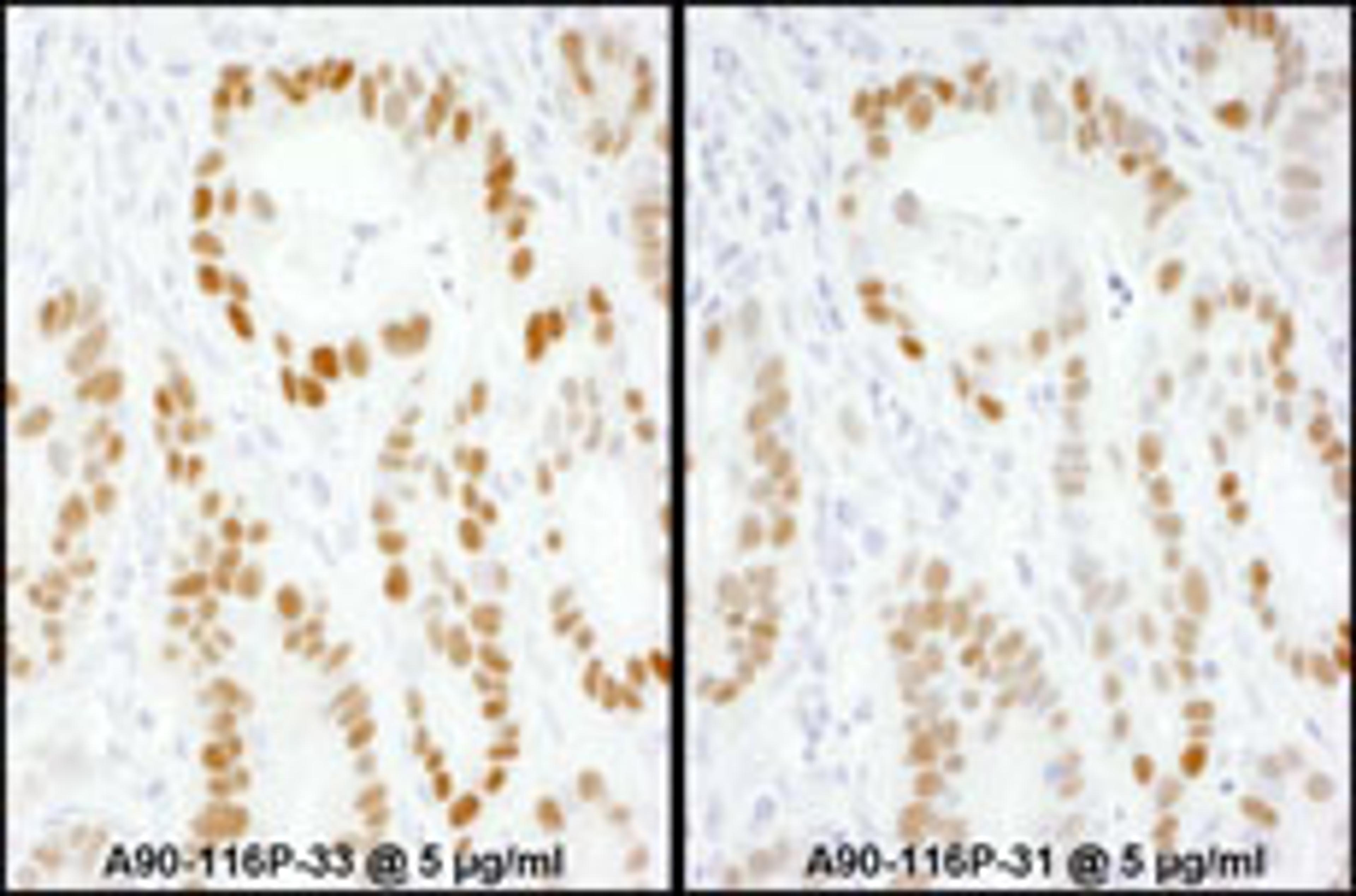 Detection of human p53 by immunoperoxidase.