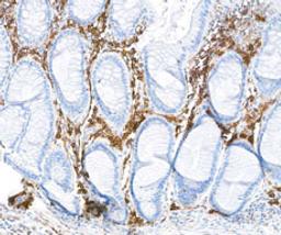 Detection of human CD38 in FFPE colon carcinoma by immunohistochemistry.