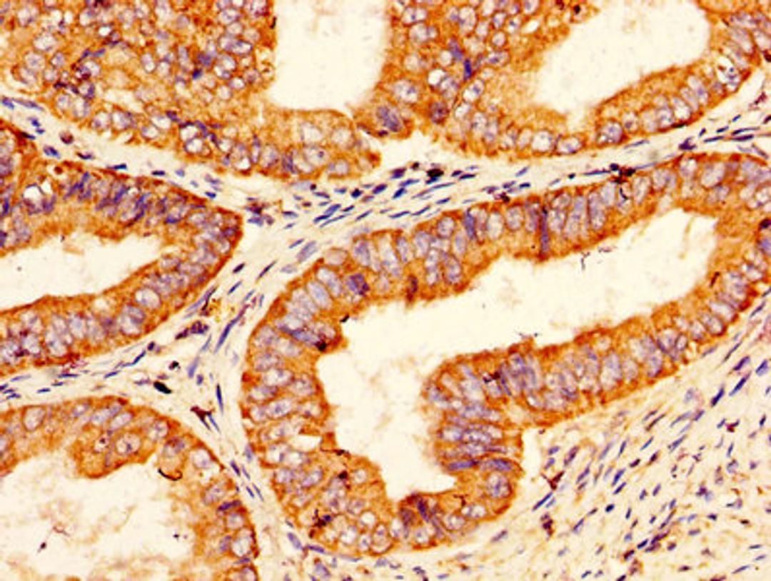 IHC image of CSB-PA018754LA01HU diluted at 1:200 and staining in paraffin-embedded human endometrial cancer performed on a Leica BondTM system. After dewaxing and hydration, antigen retrieval was mediated by high pressure in a citrate buffer (pH 6.0). Section was blocked with 10% normal goat serum 30min at RT. Then primary antibody (1% BSA) was incubated at 4&deg;C overnight. The primary is detected by a biotinylated secondary antibody and visualized using an HRP conjugated SP system.