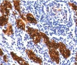 IHC testing of FFPE thyroid tissue stained with Thyroglobulin antibody (clone TG157-2).