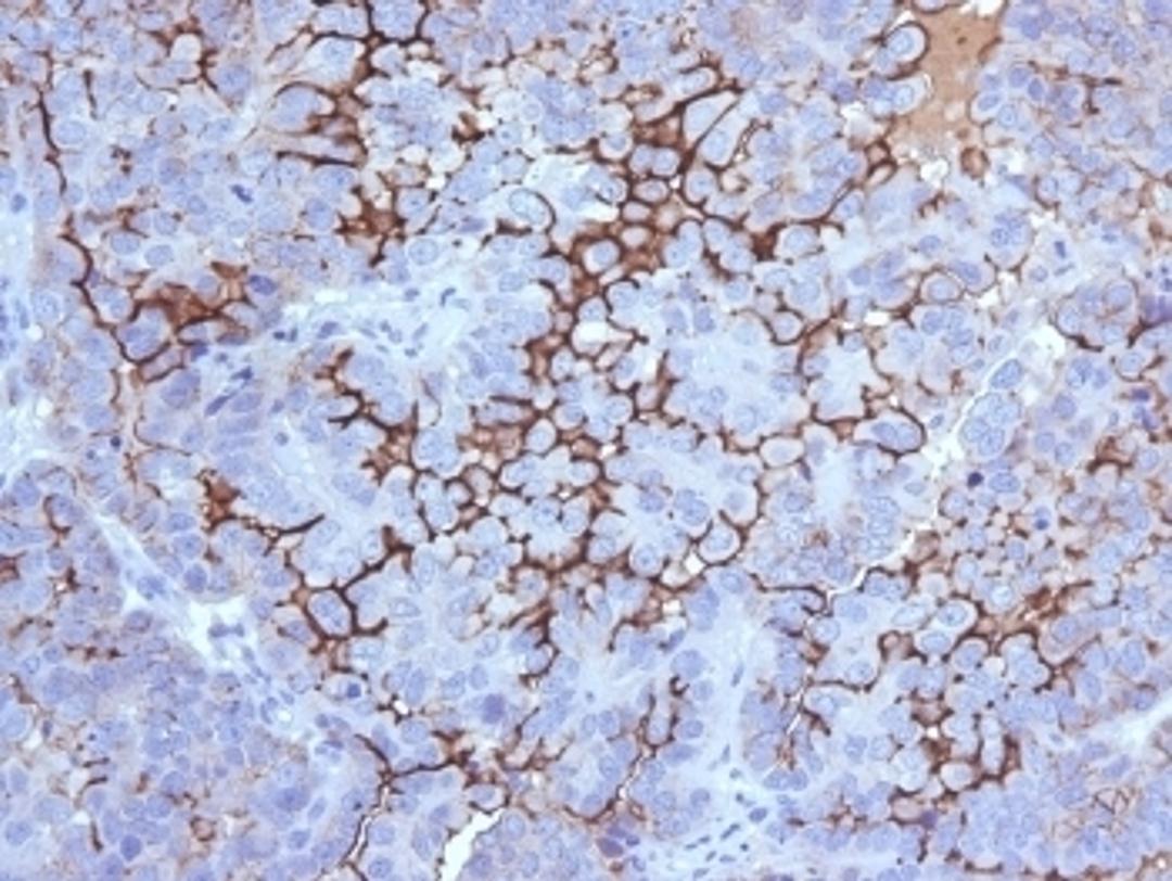 IHC testing of FFPE human ovarian carcinoma with MUC16 antibody (clone 5E11). Required HIER: steam section in pH6 citrate buffer for 20 min and allow to cool prior to testing.