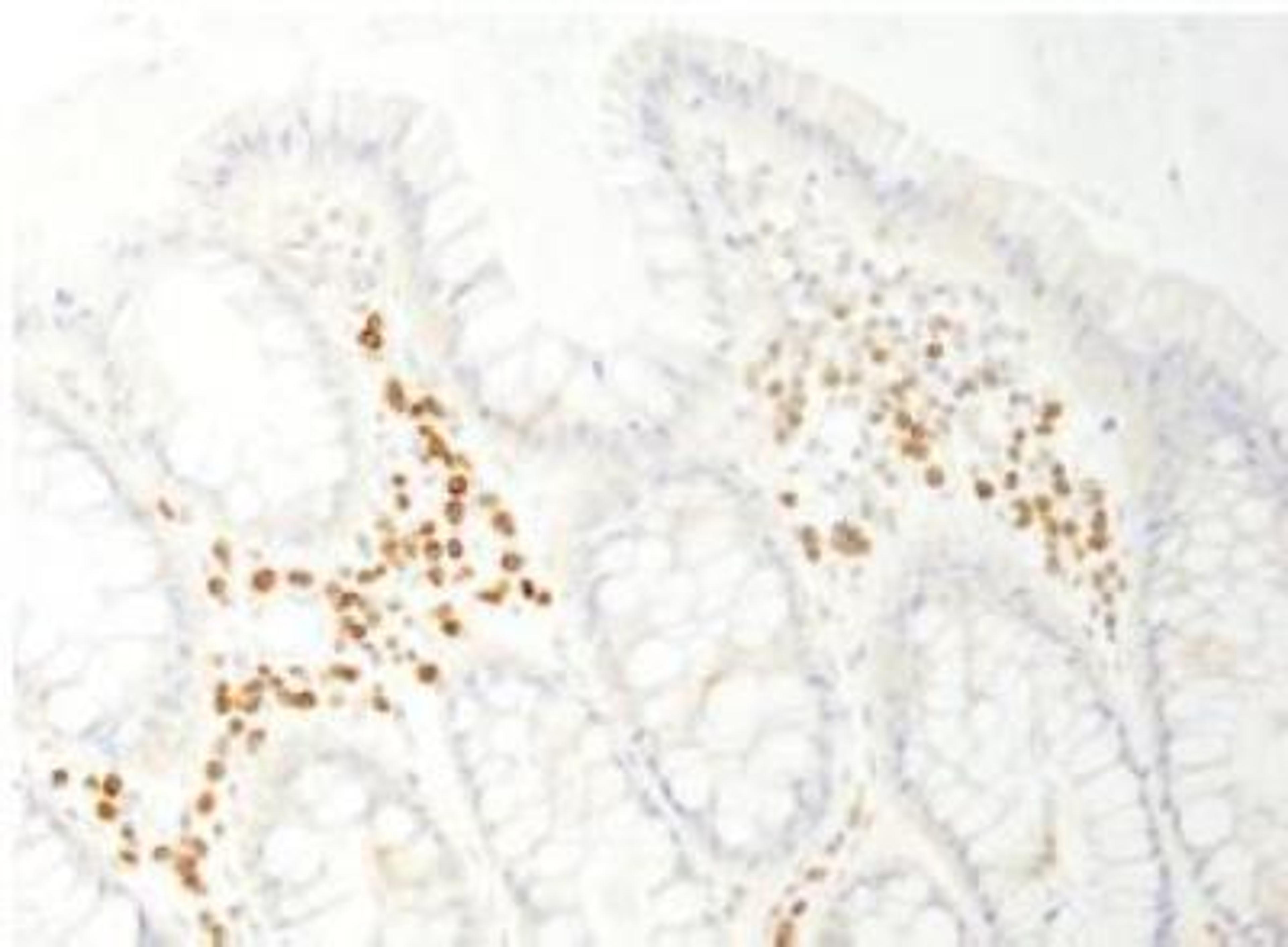 Immunohistochemistry-Paraffin: PABPC4 Antibody [NB100-74594] - FFPE section of human colon carcinoma. Dilution: 1:200 (1ug/ml).